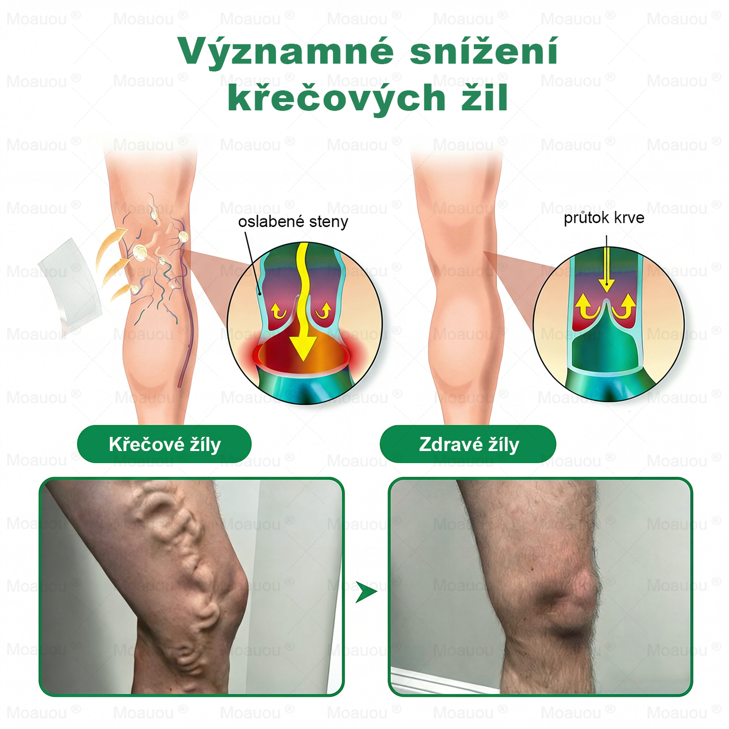 🇨🇿👨‍⚕️✅✅Moauou® 𝐕𝐞𝐢𝐧 𝐓𝐚𝐫𝐠𝐞𝐭 𝐌𝐢𝐜𝐫𝐨𝐧𝐞𝐞𝐝𝐥𝐞 𝐏𝐚𝐭𝐜𝐡⚡Okamžitá úleva, dlouhodobé výsledky - Velký výprodej